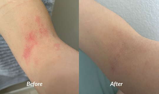 Eczema (red patches or flaky) on inner elbow before and after success